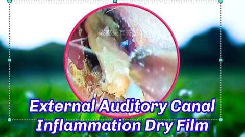 External Auditory Canal Inflammation Dry Film