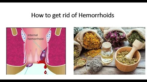 Hemorrhoids & Piles - Nautrual Treatment Options