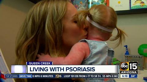 Toddler diagnosed with extreme case of psoriasis