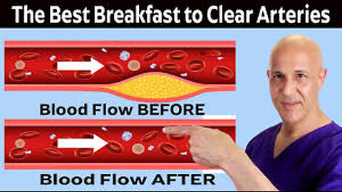 The Healthiest Breakfast to Clean and Open Arteries (Prevent Heart Attack & Stroke) Dr. Mandell