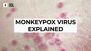 WATCH: The Monkeypox virus explained