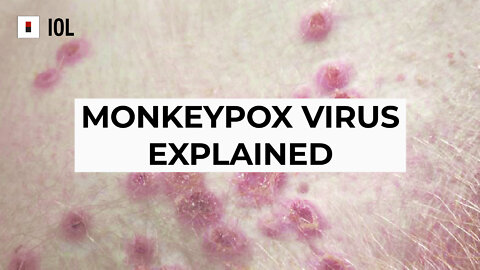 WATCH: The Monkeypox virus explained