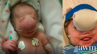 Baby Born With Sac Covering His Face Looks So Different After Surgery To Remove It