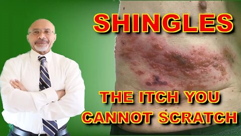 Shingles (Why The Itch Is Hard To Treat)