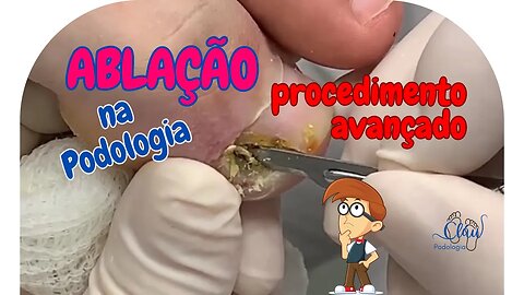 ABLAÇÃO na podologia, procedimento AVANÇADO #unhas #pes #dor