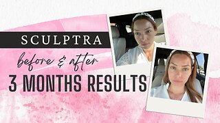 Sculptra before and After - The treatment that stimulates collagen production.