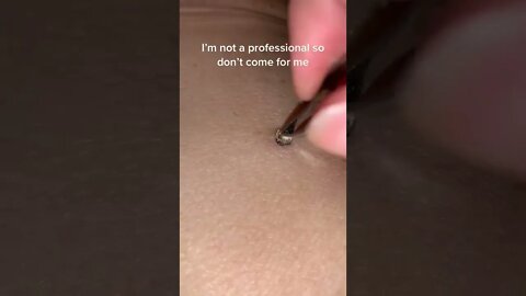 20 Year Old Blackhead Removal