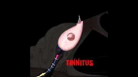 Tinnitus and traumatic sound: R Pujol, S Blatrix