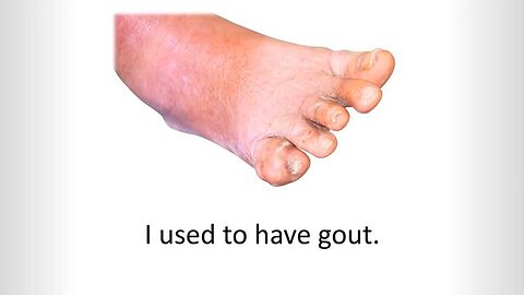 Beating Gout for Good: The Ultimate Solution