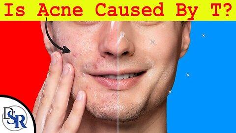 Does Testosterone Cause Acne & How To Prevent Pimples