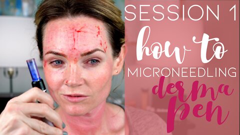 Microneedling Session #1
