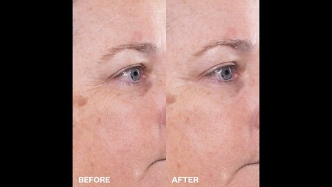 In three days, get remove of under-eye bags and wrinkles with eye exercises