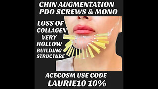 Chin Augmentation PCL Non Surgical