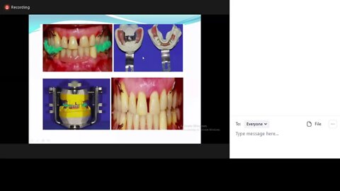 Prosthodontics L8 part2 (Correcting the occlusal contacts)