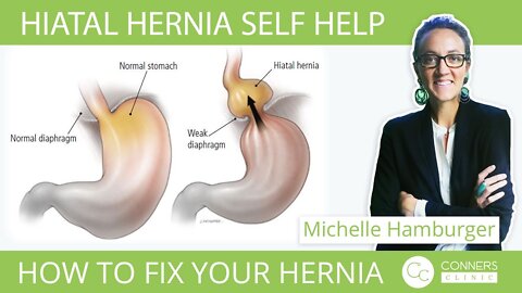 Hiatal Hernia Self Help