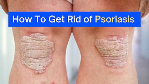 cure your Psoriasis | Get rid of Psoriasis naturally