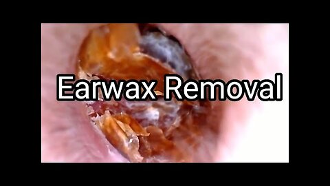 Weirdly satisfying video of earwax removal