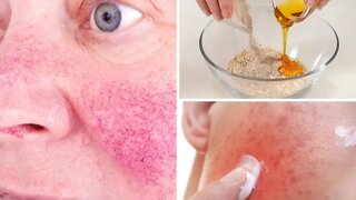 5 Natural Remedies To Get Rid Of Rosacea (Skin Redness)