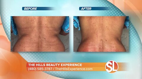 The Hills Beauty Experience: How to tighten your skin and get rid of fat