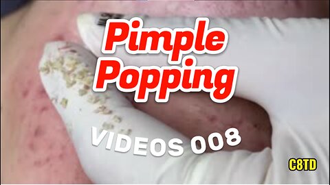 Satisfying Pimple Popping Videos 008