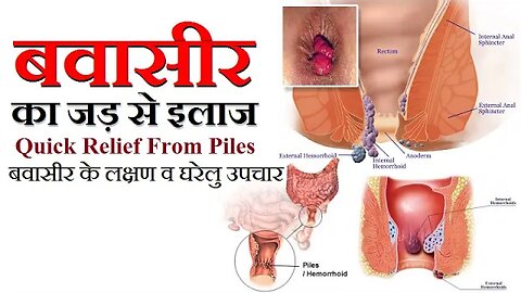 Bawasir Piles Problem Treatment | बवासीर होने के लक्षण व् उपचार | Internal or External Bawaseer