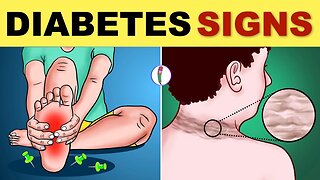Diabetes Signs & Symptoms