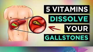 5 Vitamins To DISSOLVE Your GALLSTONES