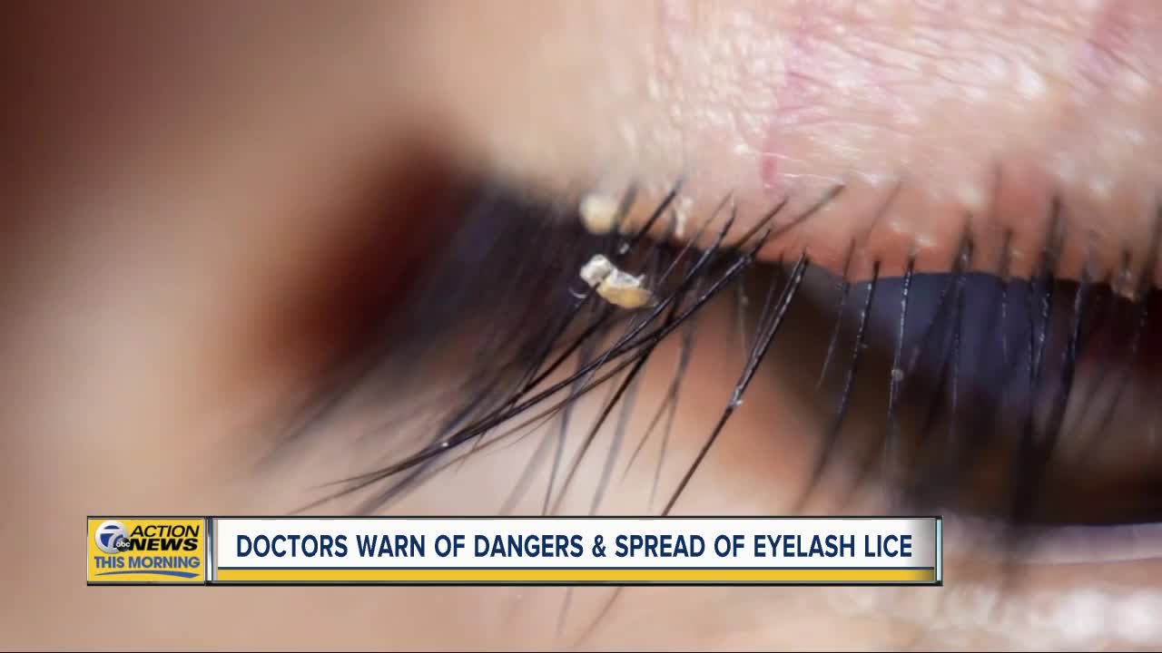 Doctors warn of lice found in eyelash extensions