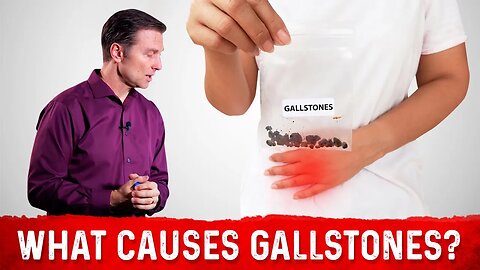Does a High Fat Diet Causes Gallstones? – Dr. Berg