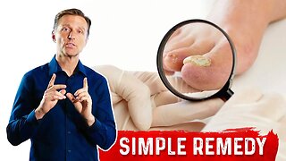 Use Epsom Salt For Toenail Fungus - Treatment For Toenail Fungus – Dr.Berg