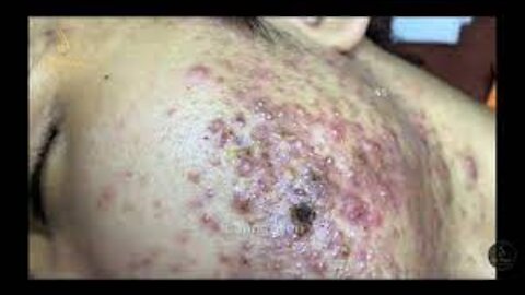 Relaxing SPA Pimple Popping videos l Relax Every Day With SPA #1