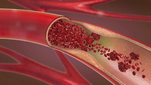 How To Remove Plaque From Your Arteries - Dr Tim O'Shea
