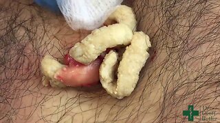 Removal of a large epidermal cyst along the mid-chest