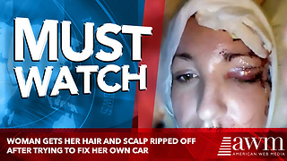 Woman Gets Her Hair And Scalp Ripped Off After Trying To Fix Her Own Car