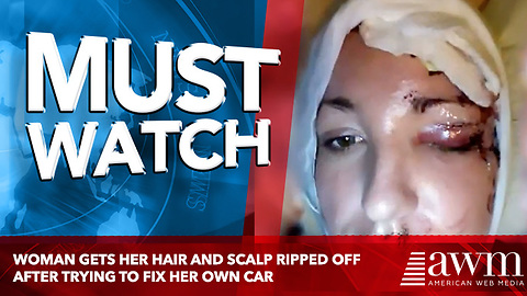 Woman Gets Her Hair And Scalp Ripped Off After Trying To Fix Her Own Car