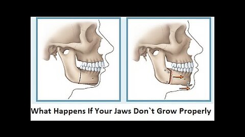 What Happens If Your Jaws Don`t Grow Properly by Prof John Mew