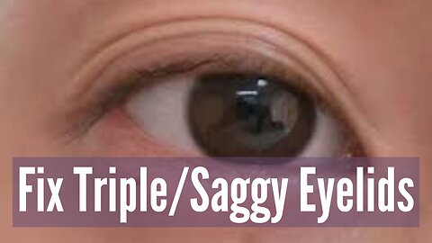 Fix Tripple Eyelids!