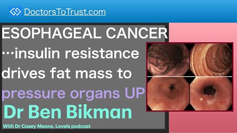 BEN BIKMAN 3 | ESOPHAGEAL CANCER…insulin resistance drives fat mass to pressure organs UPWARD!
