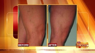 It's Time to Address Your Spider and Varicose Veins