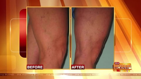 It's Time to Address Your Spider and Varicose Veins