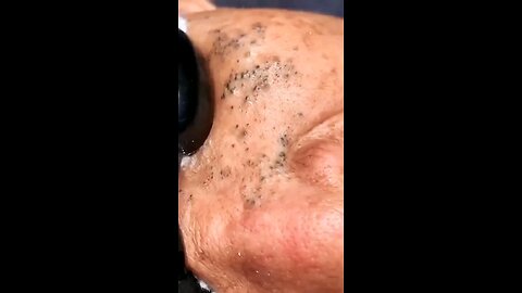 Blackheads episode 19