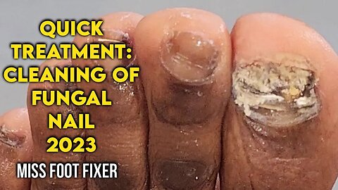 QUICK TREATMENT : CLEANING OF A FUNGAL NAIL IIN 7 MINUTES BY FOOT SPECIALIST MISS FOOT FIXER