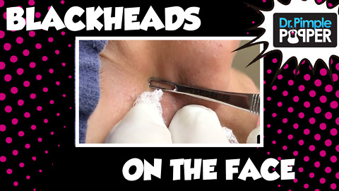 Blackheads on a Young Teenager's Face
