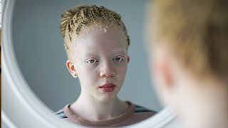 I’m Black, Even With Albinism