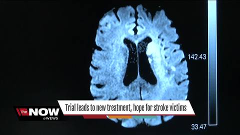 Groundbreaking DAWN study findings change treatment, giving hope for stroke victims