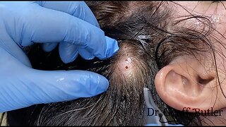 Removal of a scalp cyst