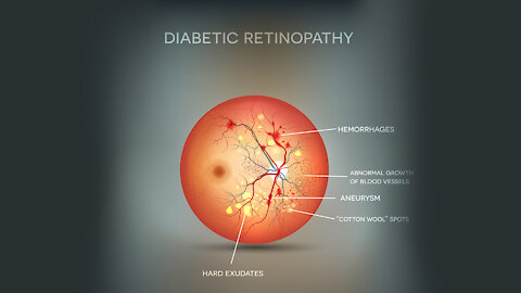 Diabetic Retinopathy Help