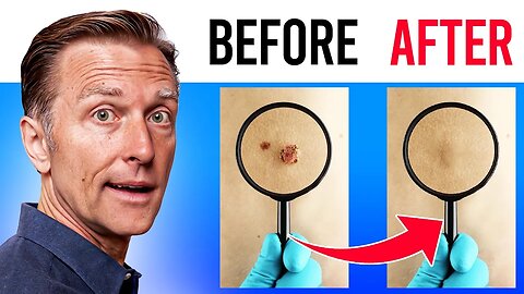 How To Remove Skin Tags And Warts Overnight