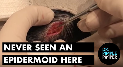 First Time I've Seen an Epidermoid Cyst Here!