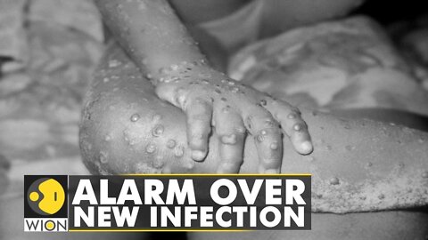 Israel reports first case of Monkeypox, alarm over new infection | World News